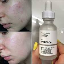 The Ordinary Niacinamide 10% + Zinc 1 % - 30ml |Oil Control, Pore Minimizing & Blemish Solution Serum